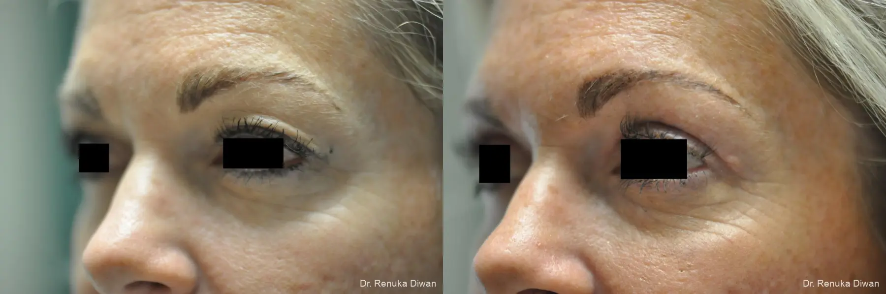 Blepharoplasty: Patient 1 - Before and After 2