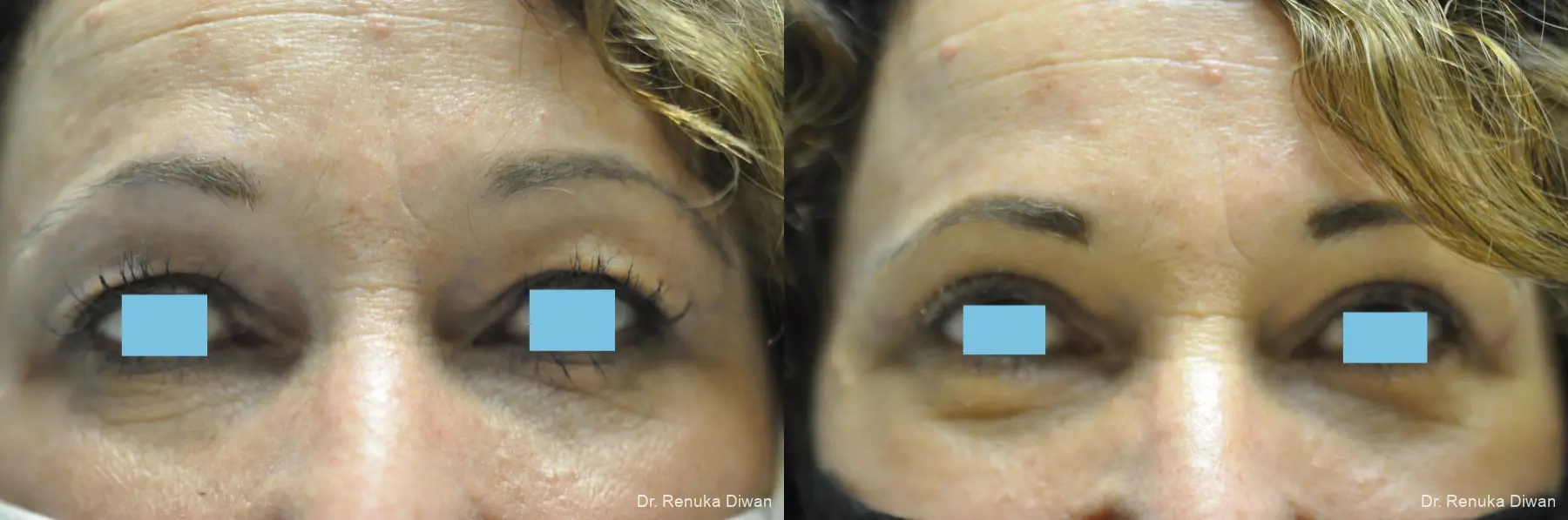 Blepharoplasty: Patient 5 - Before and After 2