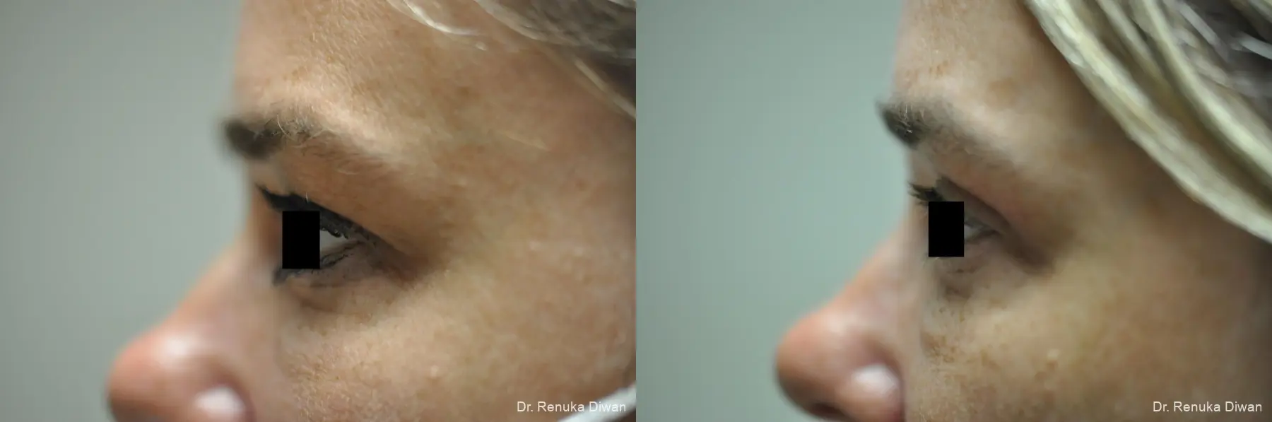 Blepharoplasty: Patient 3 - Before and After 2