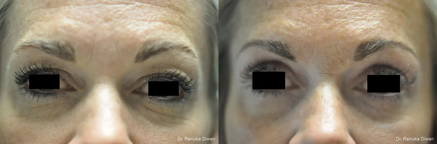 Blepharoplasty: Patient 1 - Before and After 3