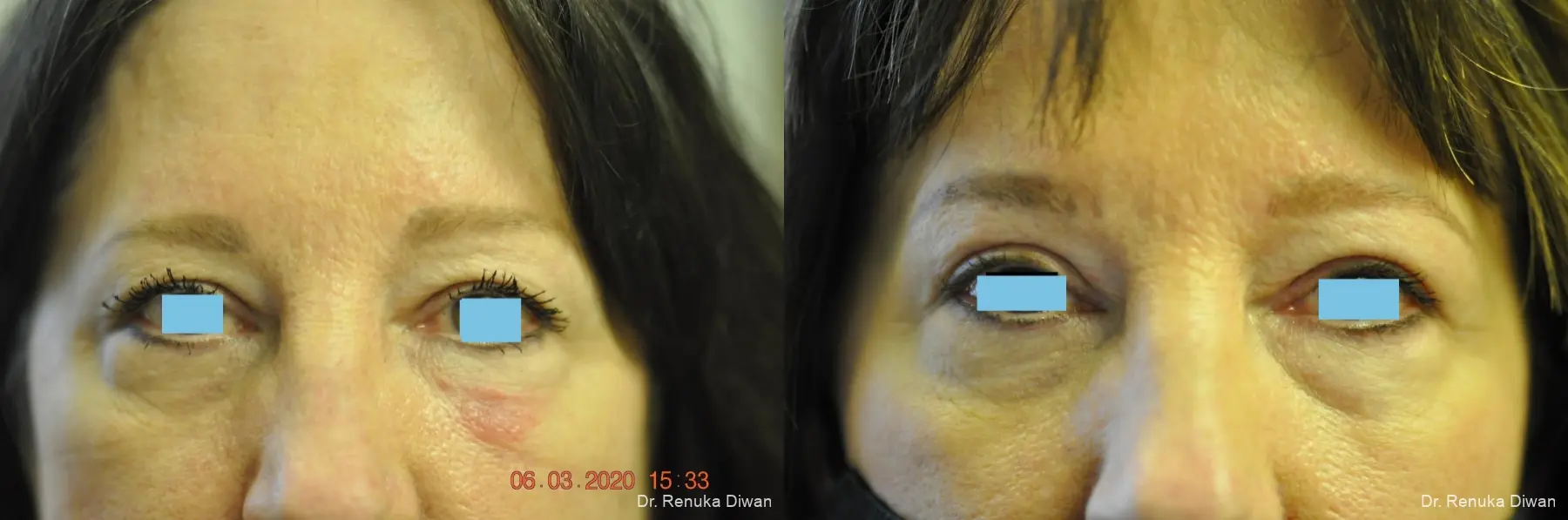 Blepharoplasty: Patient 9 - Before and After  