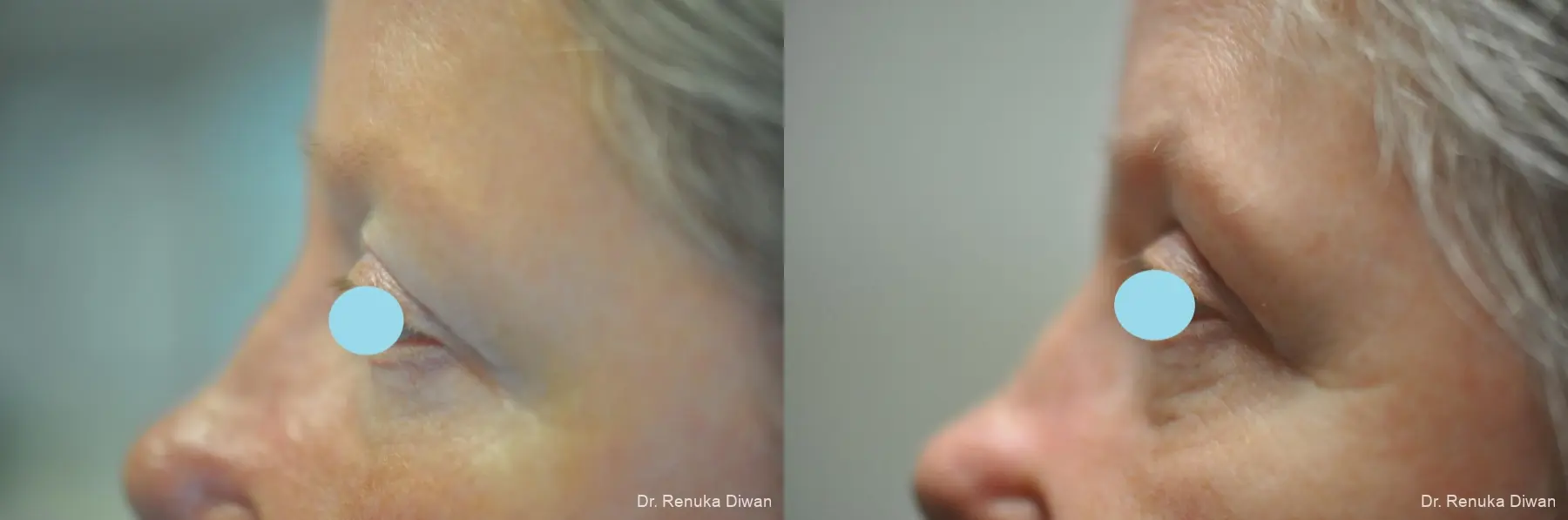 Blepharoplasty: Patient 19 - Before and After 5