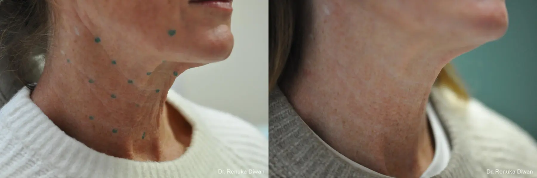 Botox Cosmetic- Neck: Patient 2 - Before and After