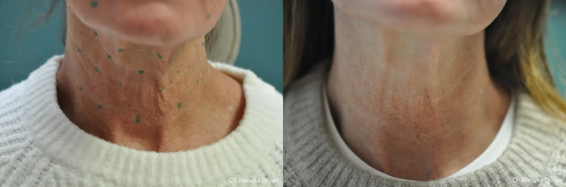 Botox Cosmetic- Neck: Patient 2 - Before and After 2