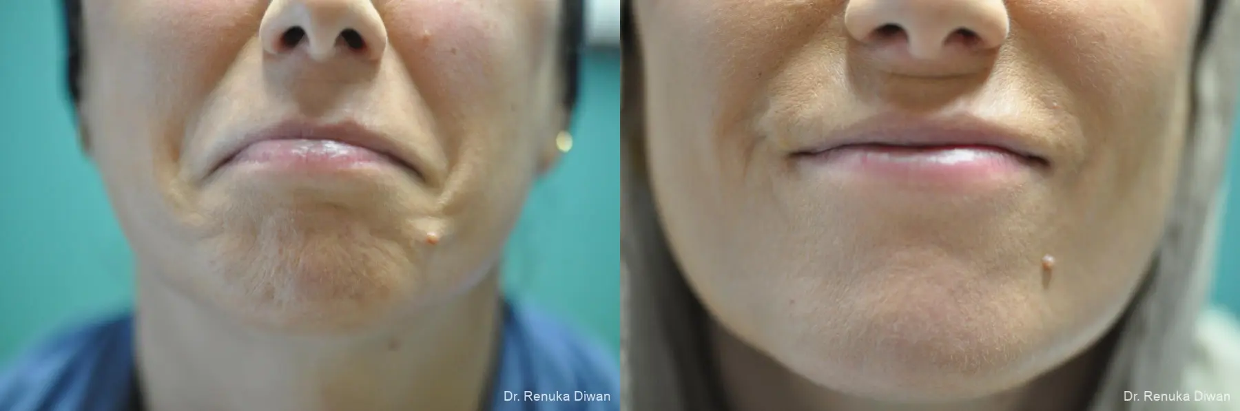BOTOX® Cosmetic: Patient 47 - Before and After 1