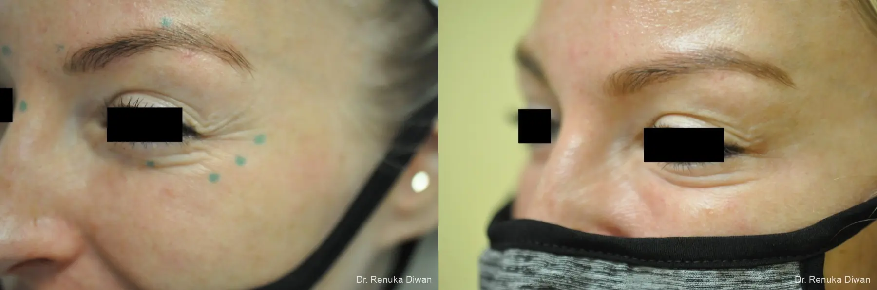 BOTOX® Cosmetic: Patient 33 - Before and After 2