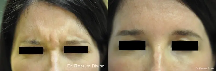 BOTOX® Cosmetic: Patient 37 - Before and After 1