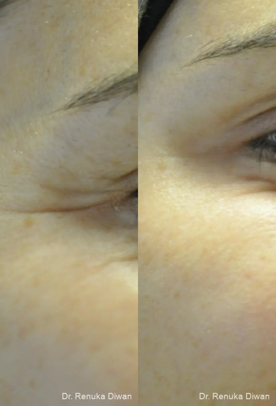 BOTOX® Cosmetic: Patient 29 - Before and After 2