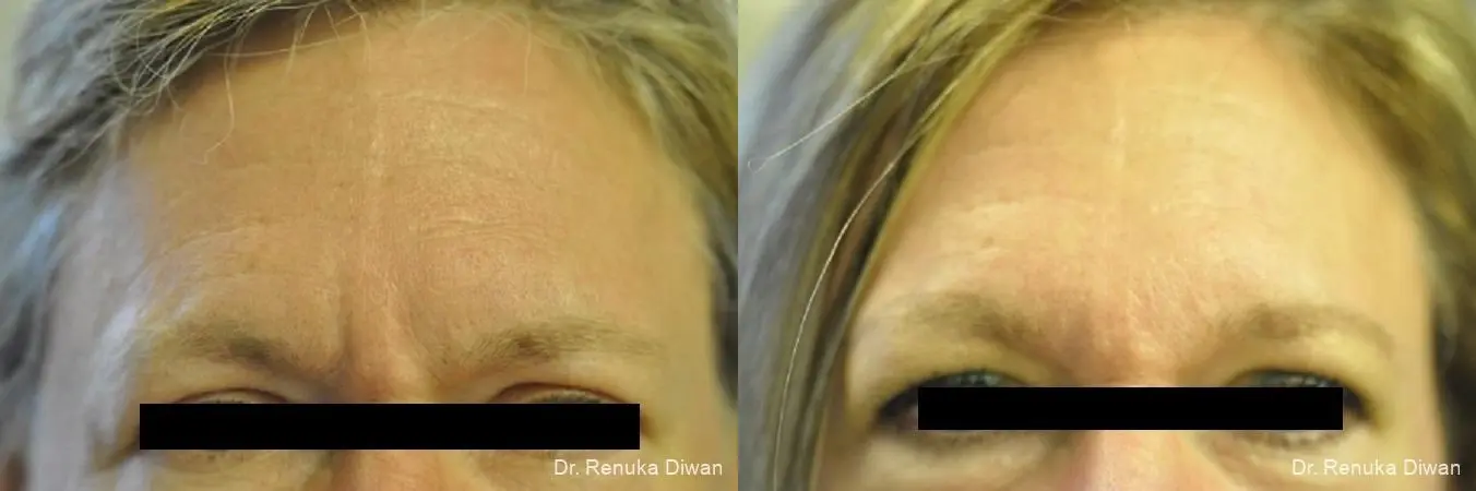 BOTOX® Cosmetic: Patient 1 - Before and After 1