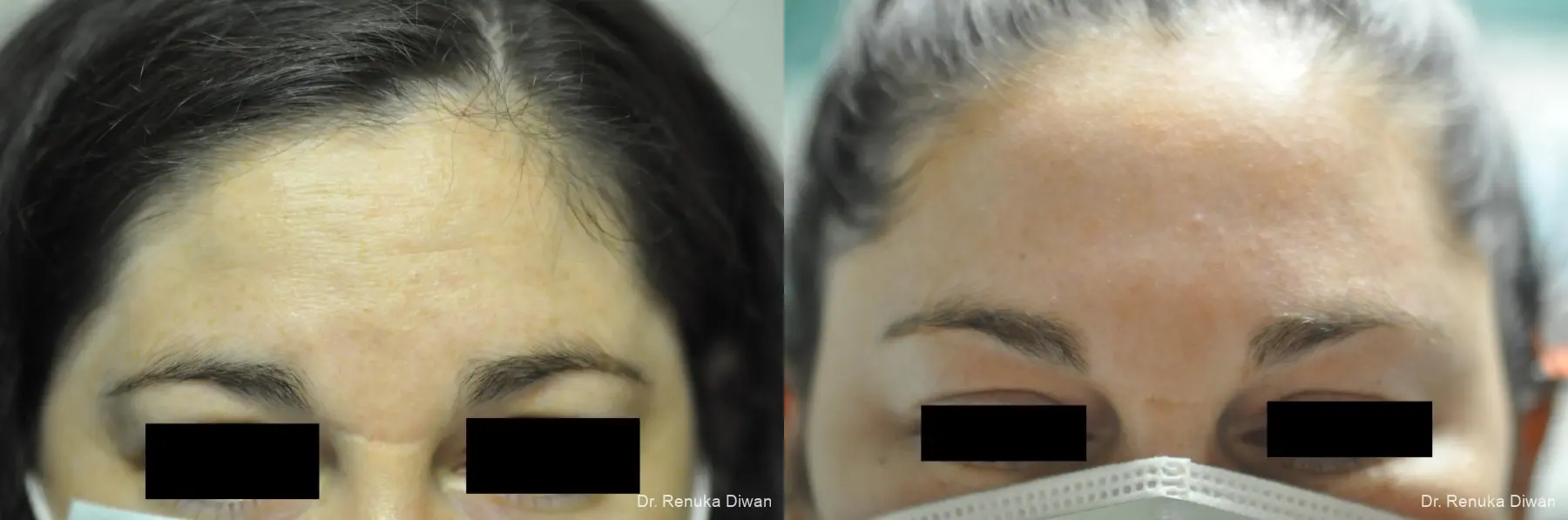 BOTOX® Cosmetic: Patient 34 - Before and After 1