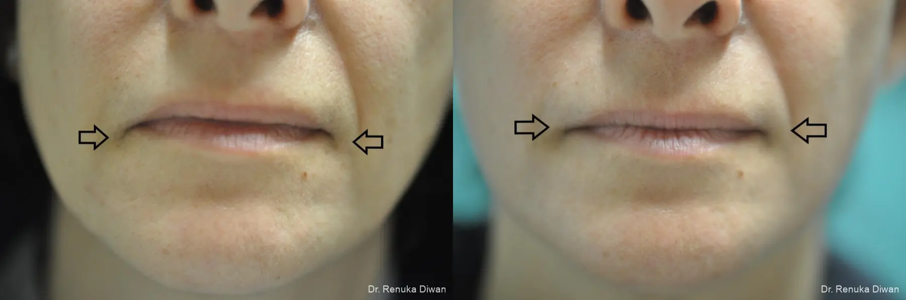 BOTOX® Cosmetic: Patient 31 - Before and After 1