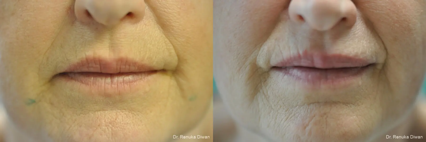 BOTOX® Cosmetic: Patient 40 - Before and After 1