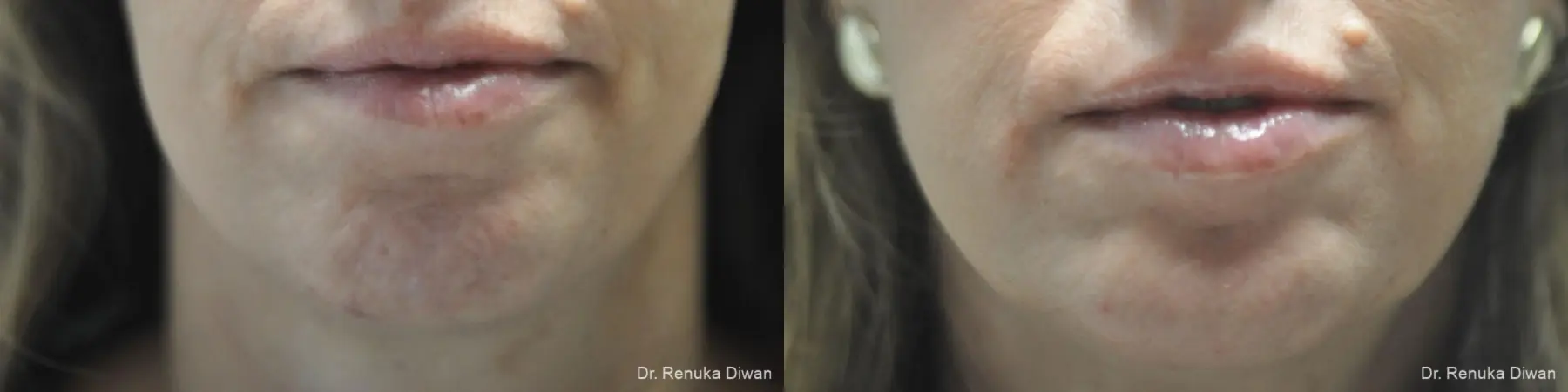 BOTOX® Cosmetic: Patient 28 - Before and After 1
