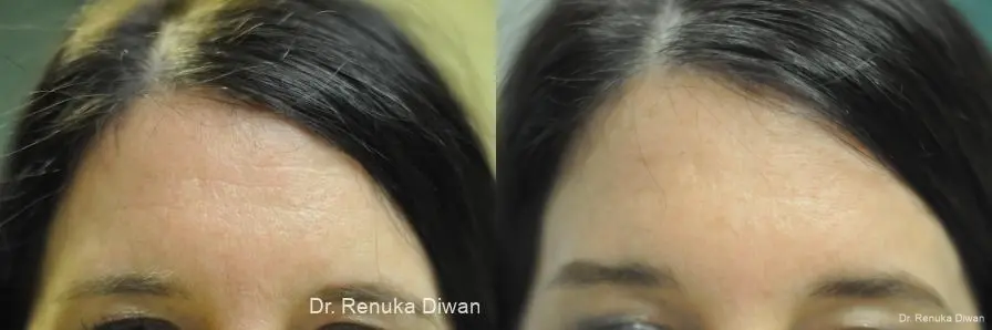 BOTOX® Cosmetic: Patient 42 - Before and After 1