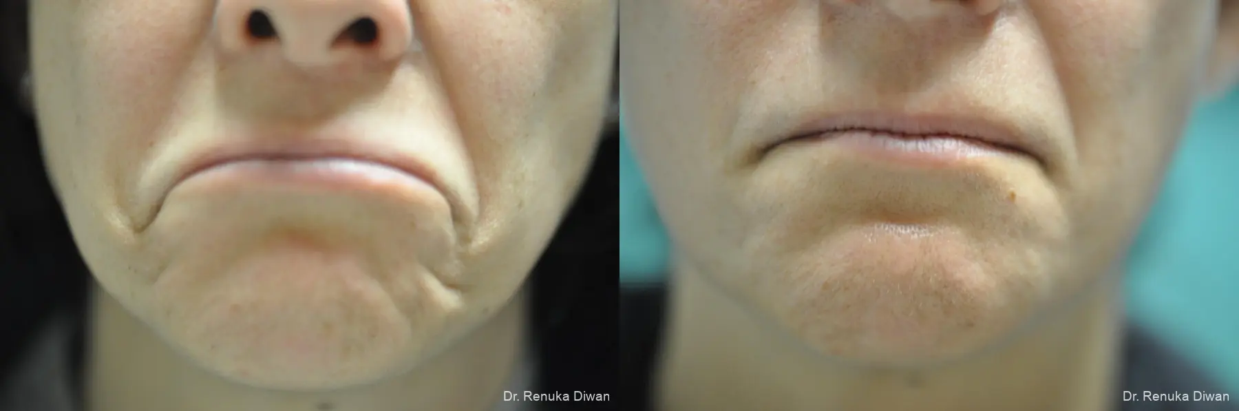 BOTOX® Cosmetic: Patient 31 - Before and After 2