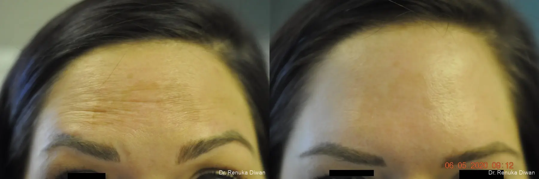 BOTOX® Cosmetic: Patient 32 - Before and After 1