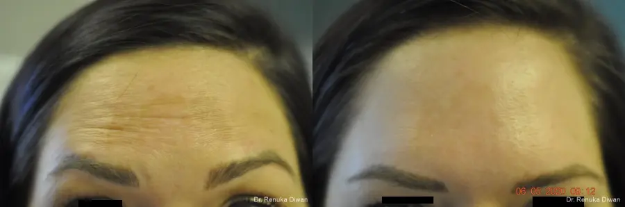 BOTOX® Cosmetic: Patient 29 - Before and After 1