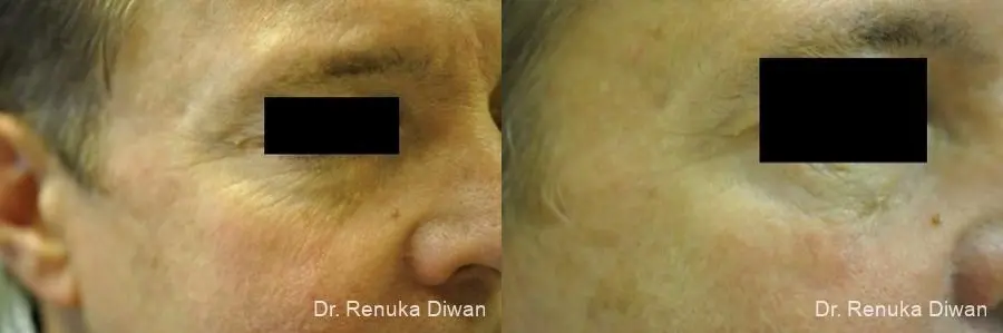 Botox-cosmetic-for-men: Patient 4 - Before and After  