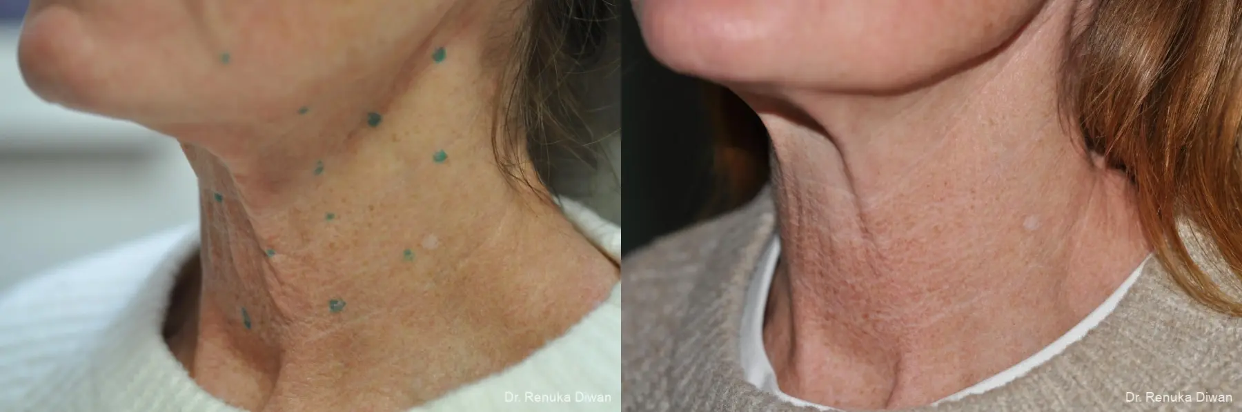 BOTOX® Cosmetic: Patient 30 - Before and After 3