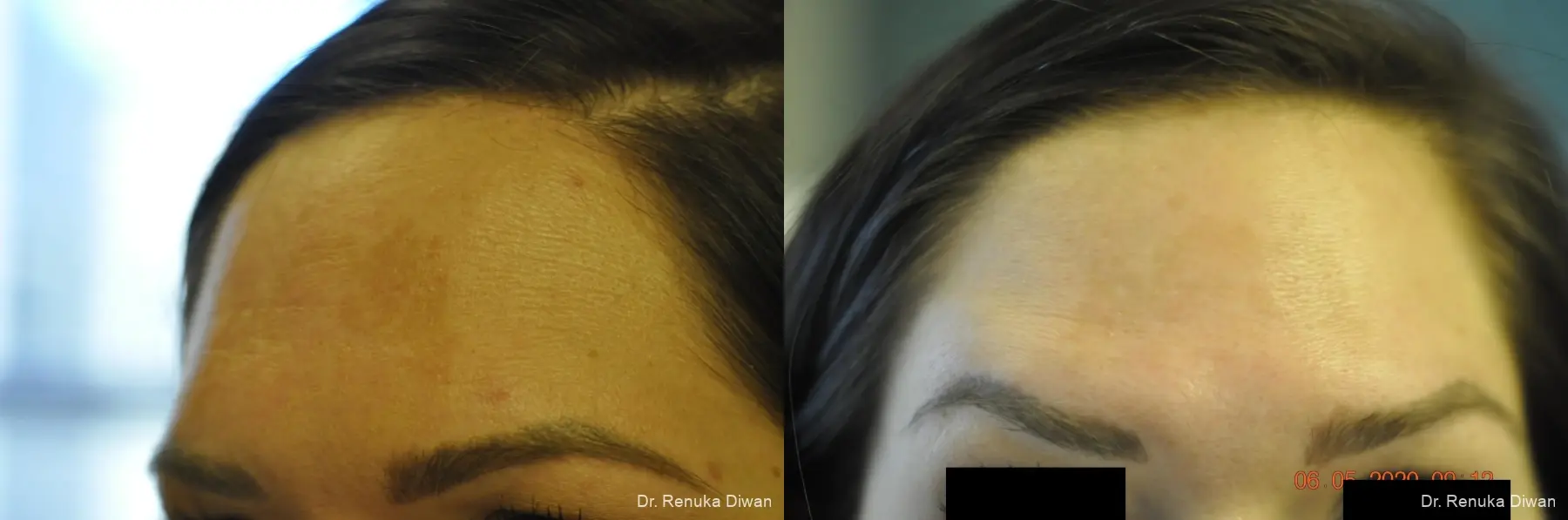 BOTOX® Cosmetic: Patient 32 - Before and After 2