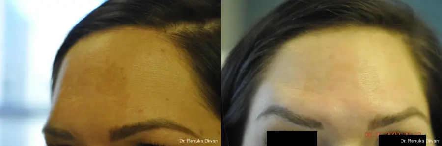 BOTOX® Cosmetic: Patient 29 - Before and After 2