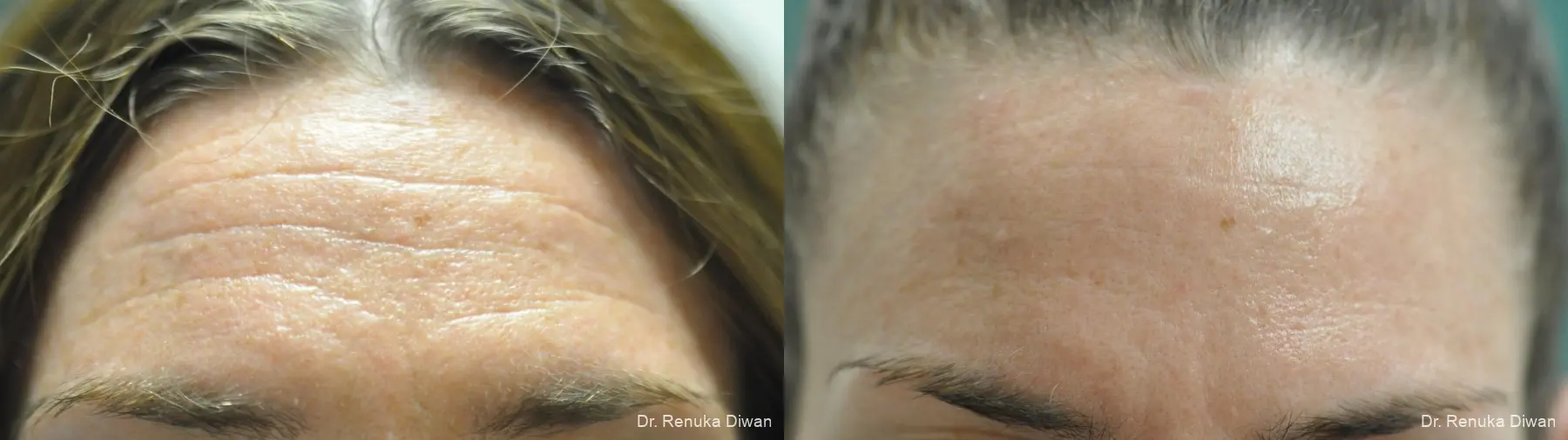 BOTOX® Cosmetic: Patient 44 - Before and After 1