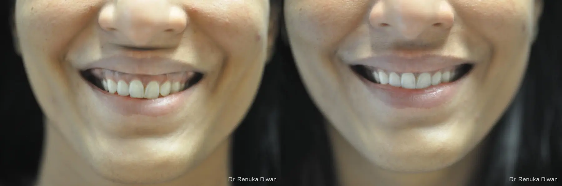 BOTOX® Cosmetic: Patient 26 - Before and After 1