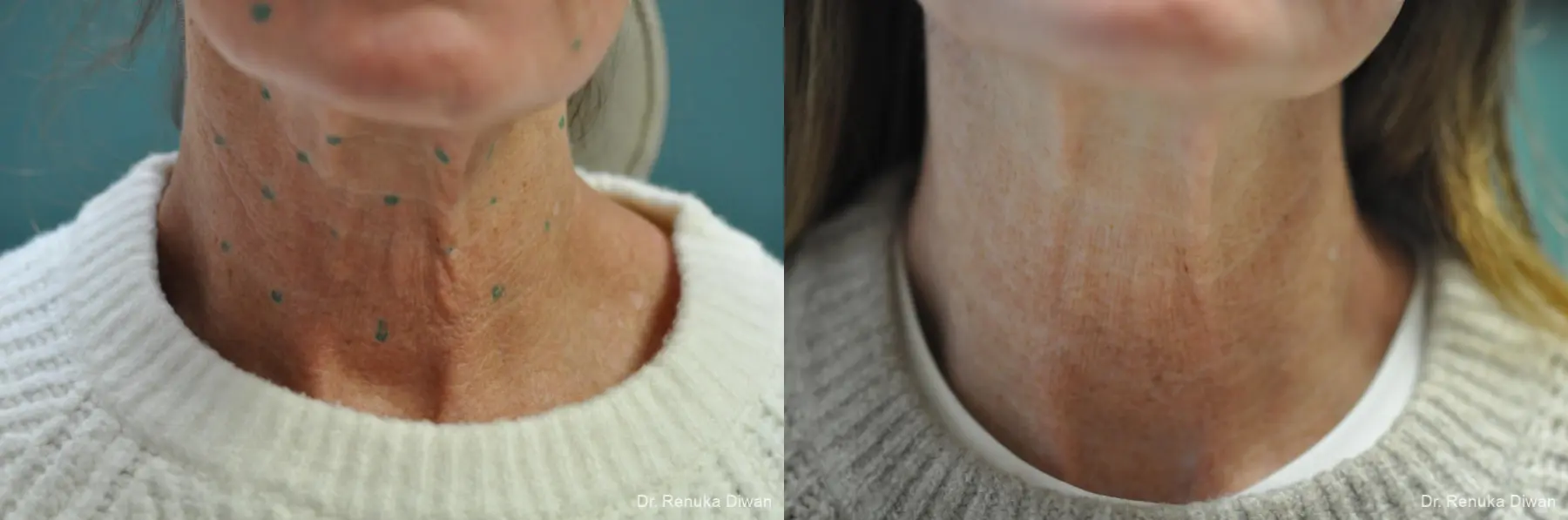 BOTOX® Cosmetic: Patient 30 - Before and After 2