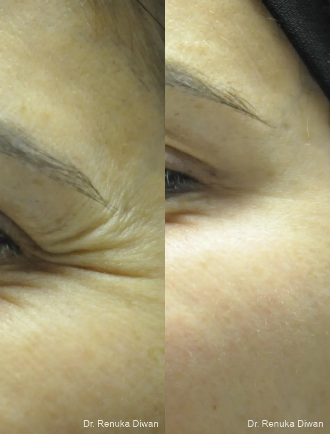 BOTOX® Cosmetic: Patient 29 - Before and After 1