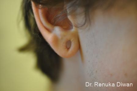 Earlobe Surgery: Patient 8 - Before 