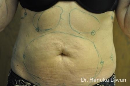 Liposuction: Patient 15 - Before 1