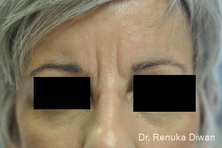 BOTOX® Cosmetic: Patient 4 - Before 