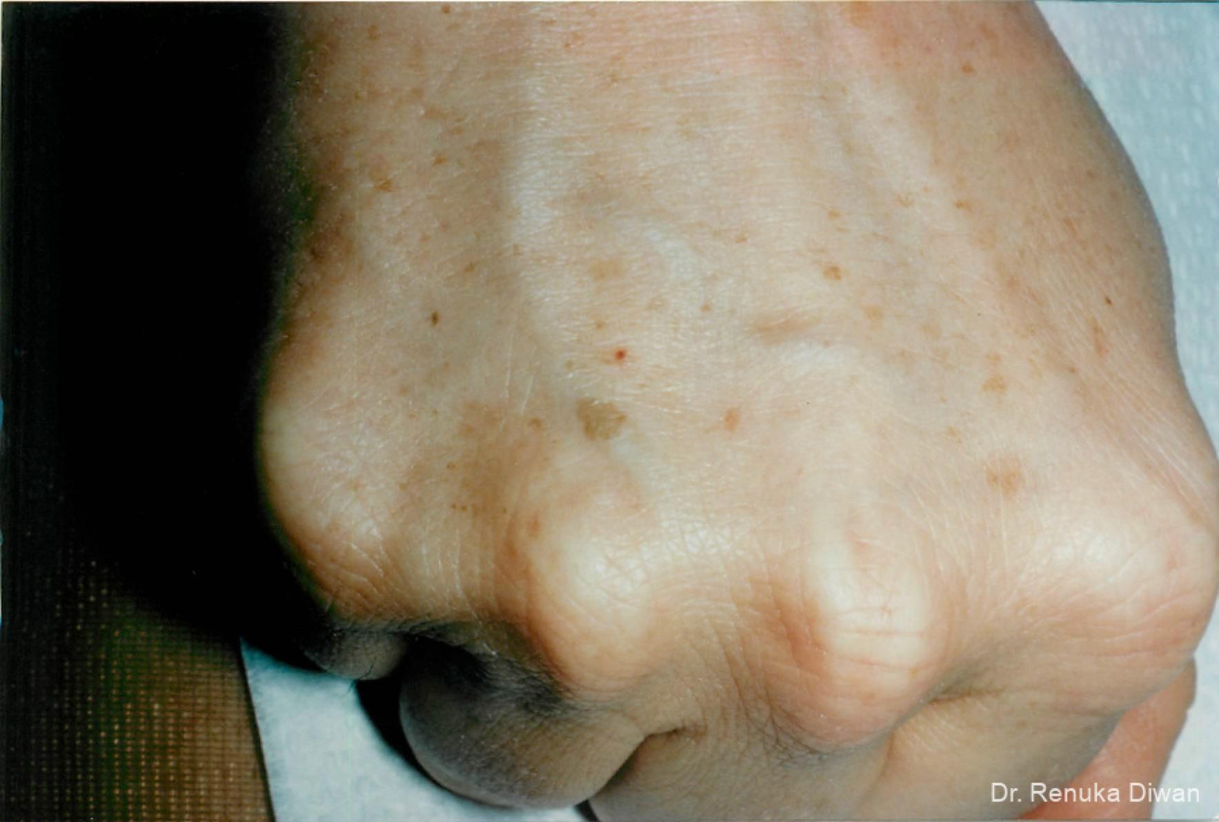 Lasers For Brown Spots: Patient 3 - Before 1