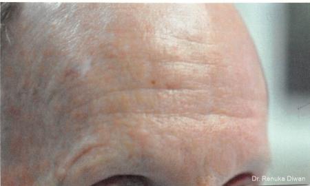 Botox Cosmetic For Men: Patient 3 - Before 1