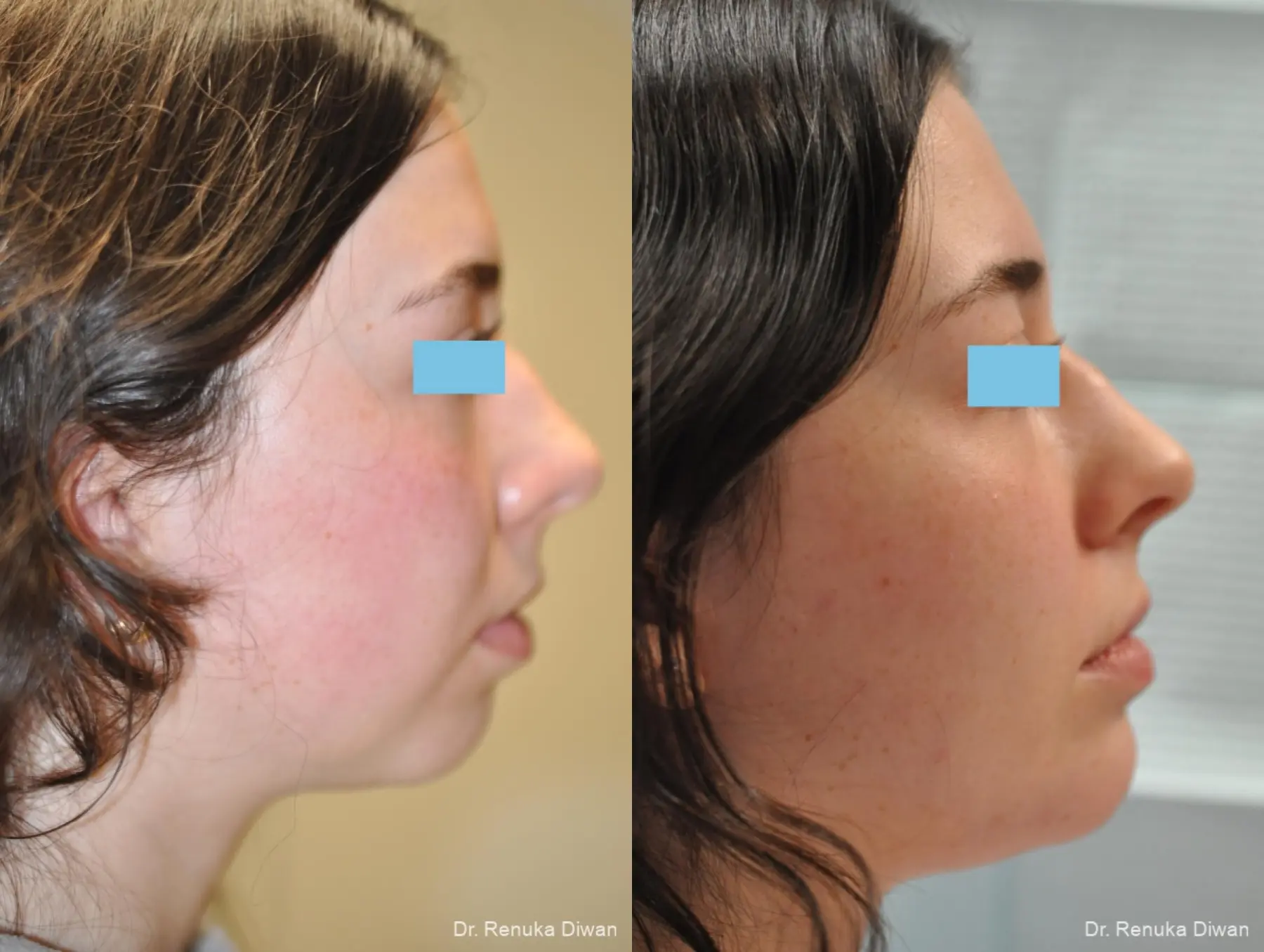 Chin Augmentation: Patient 5 - Before and After  
