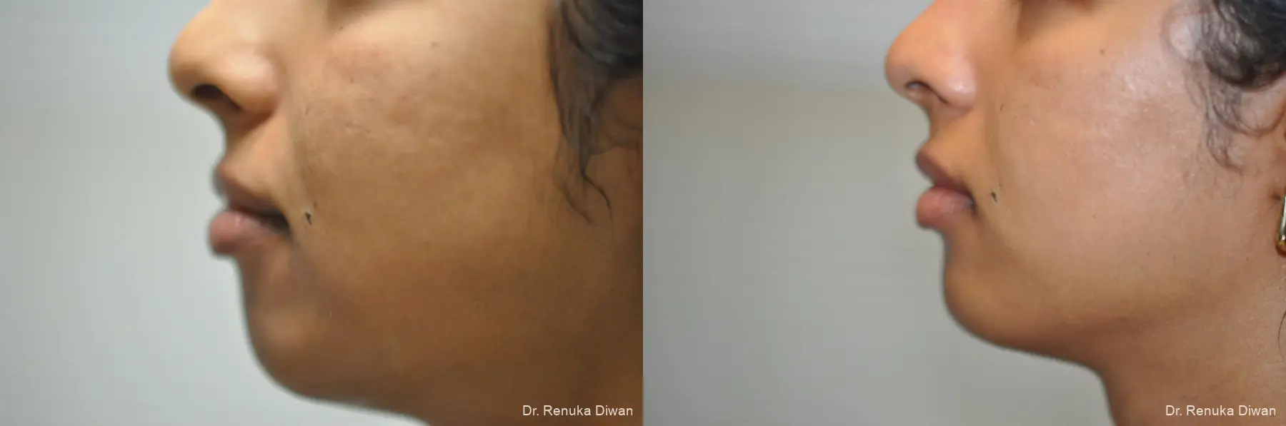 Chin Augmentation: Patient 5 - Before and After 1