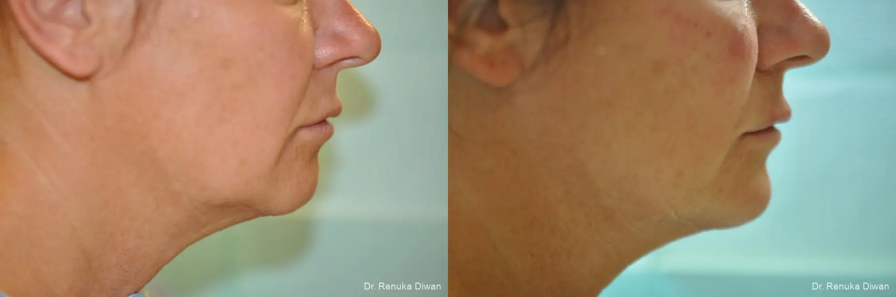 Chin Augmentation: Patient 6 - Before and After 1
