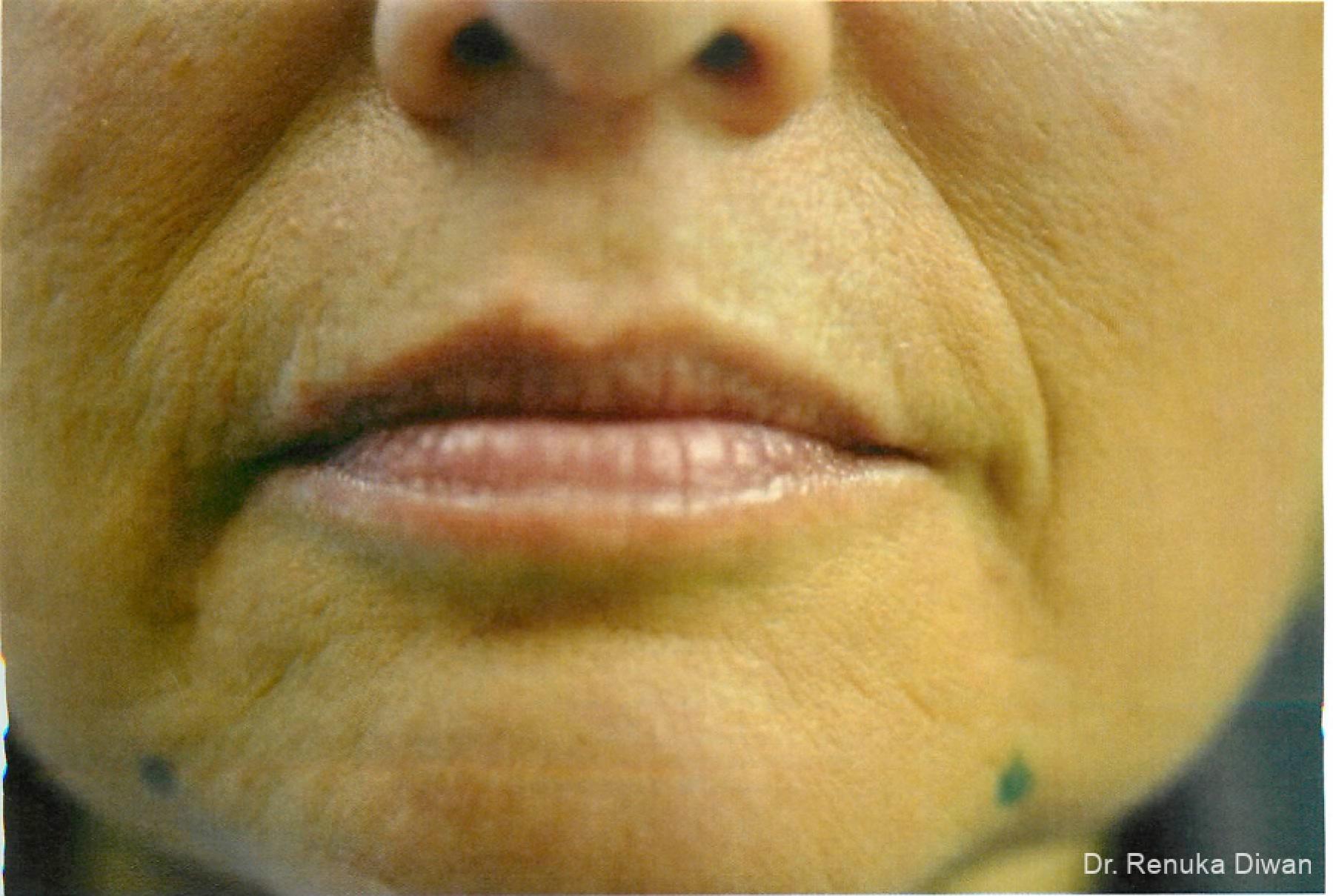 Marionette Lines: Patient 7 - Before 