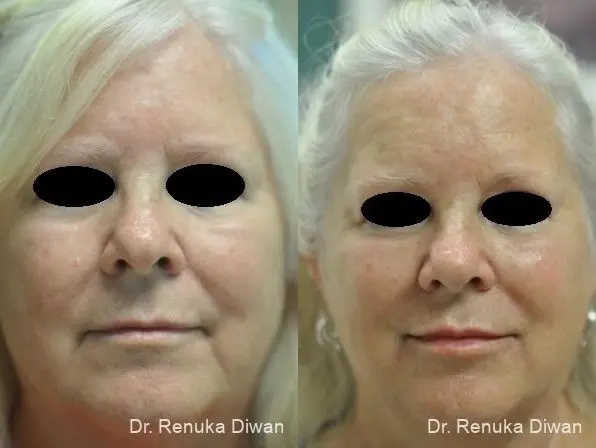 Combo Procedures - Face: Patient 4 - Before and After  