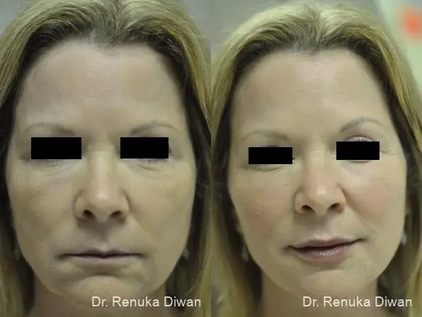 Combo Procedures - Face: Patient 3 - Before and After  