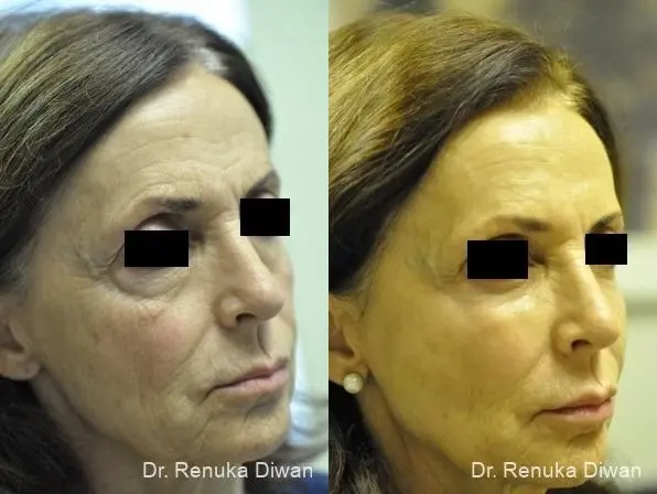 Combo Procedures - Face: Patient 5 - Before and After 1