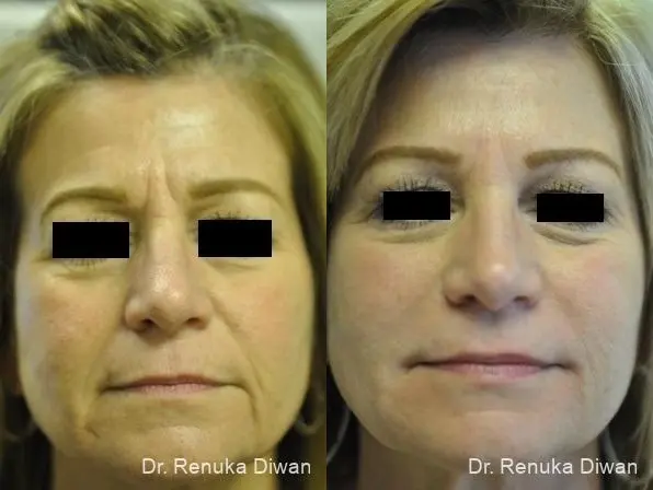 Combo Procedures - Face: Patient 2 - Before and After  