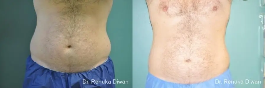 CoolSculpting®: Patient 3 - Before and After  