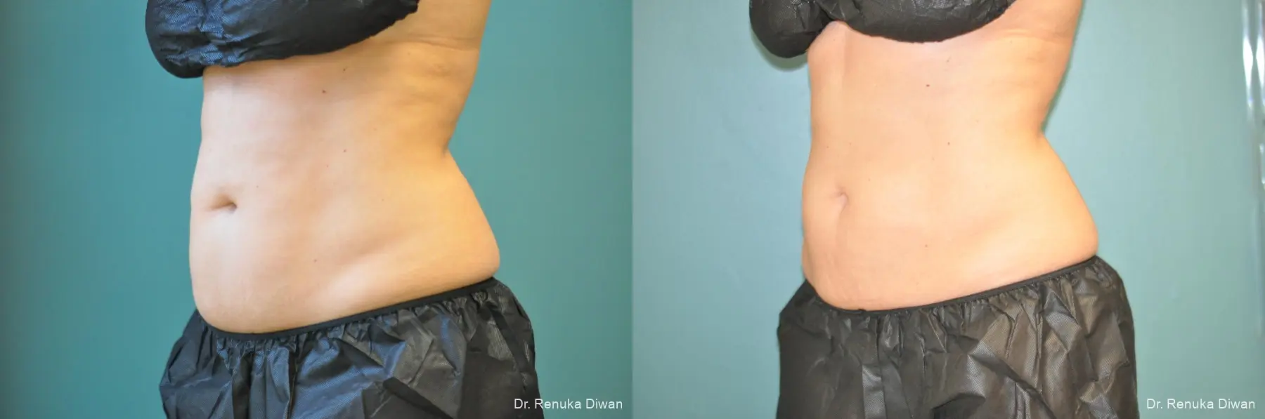 CoolSculpting®: Patient 4 - Before and After 3