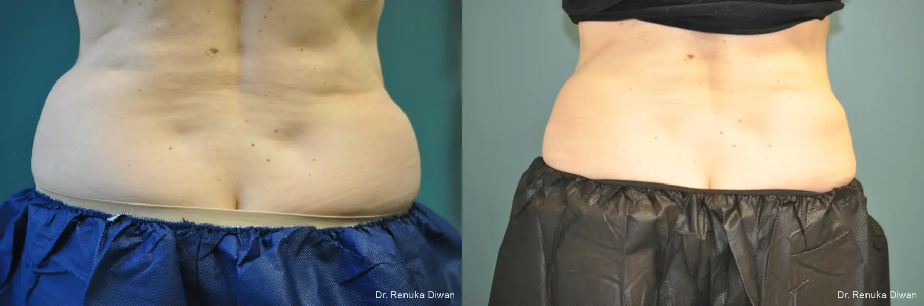 CoolSculpting®: Patient 3 - Before and After  