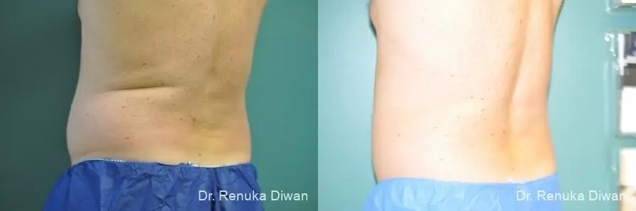 CoolSculpting®: Patient 4 - Before and After 1