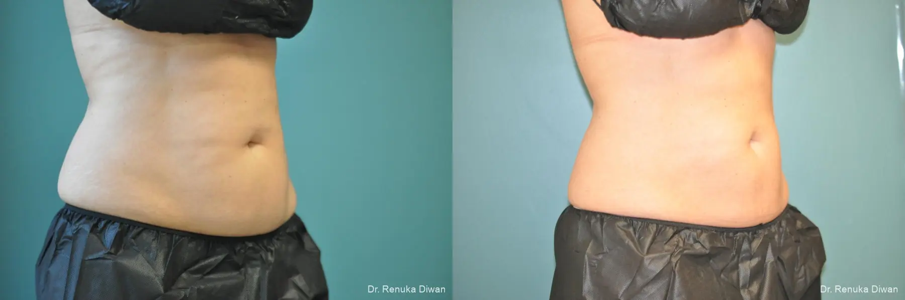 CoolSculpting®: Patient 4 - Before and After 2