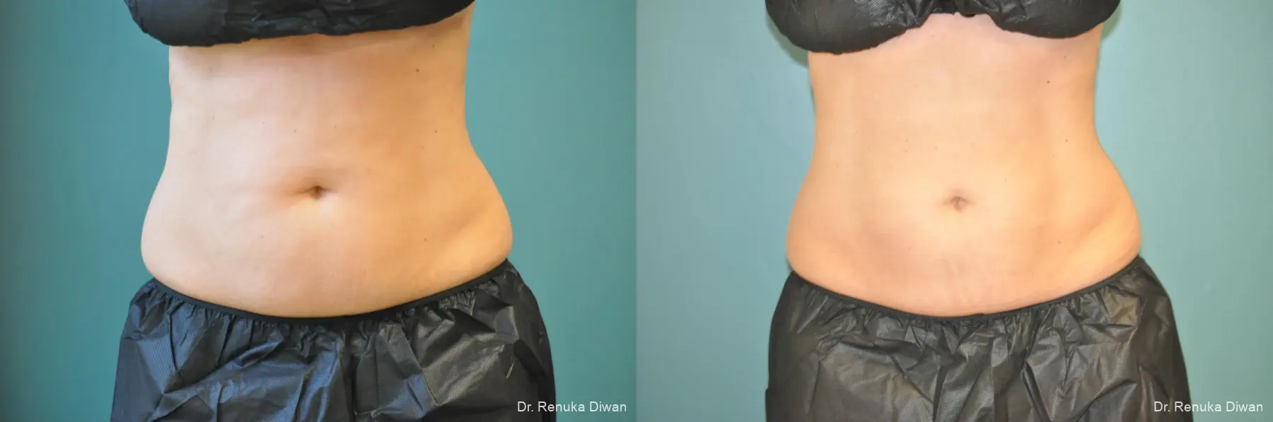 CoolSculpting®: Patient 4 - Before and After  