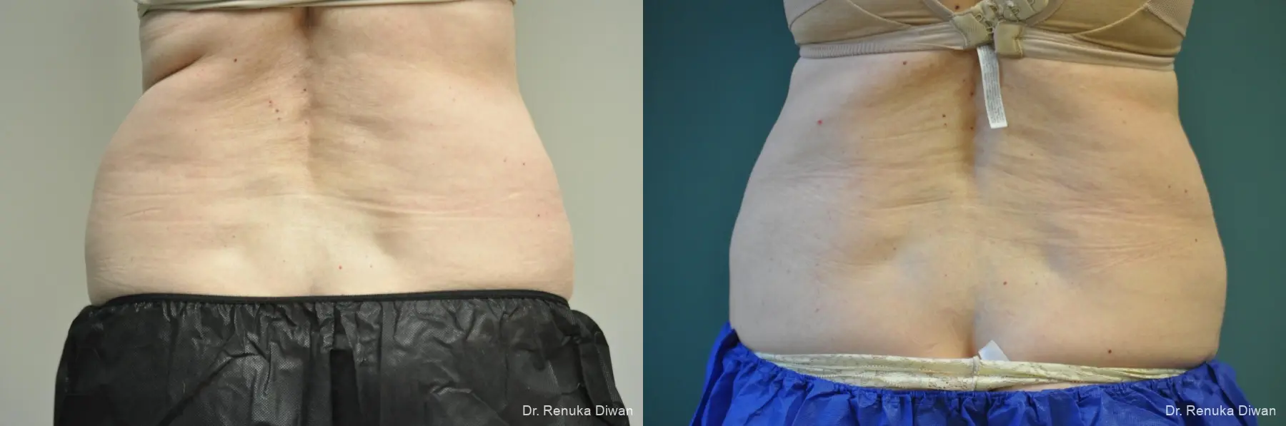 CoolSculpting®: Patient 7 - Before and After 1