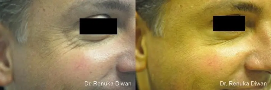 Crows Feet Creases For Men: Patient 2 - Before and After 1